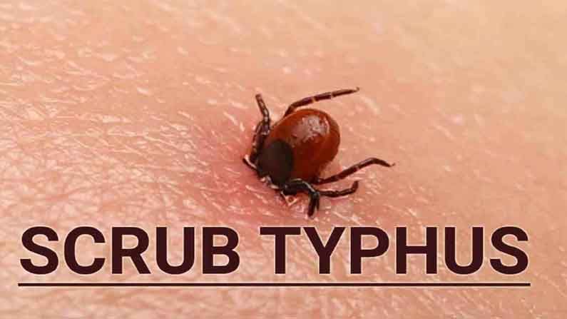 Scrub Typhu: ఉత్తర భారతంలో కొత్త కలవరం.. చిన్నారులకు ప్రబలుతున్న వింత వ్యాధి.. యూపీలో 8మంది మృత్యువాత! Scrub Typhu: ఉత్తర భారతంలో కొత్త కలవరం.. చిన్నారులకు ప్రబలుతున్న వింత వ్యాధి.. యూపీలో 8మంది మృత్యువాత!