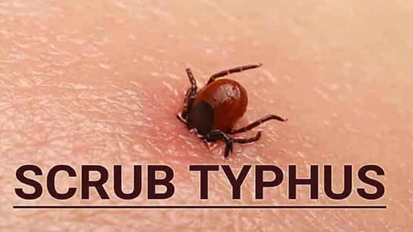 Scrub Typhus: ఉత్తర భారతంలో కొత్త కలవరం.. చిన్నారులకు ప్రబలుతున్న వింత వ్యాధి.. యూపీలో 8మంది మృత్యువాత!