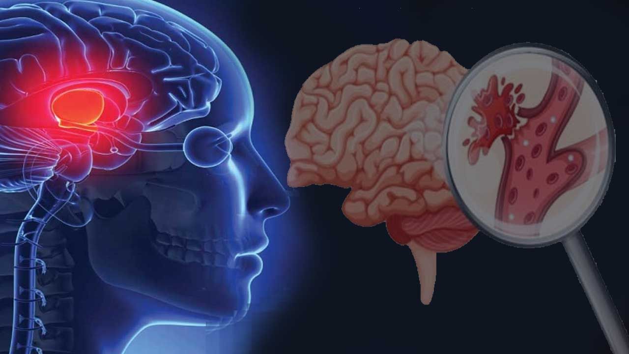 Brain Stroke Symptoms: నెల ముందు నుంచే ఈ లక్షణాలు కనిపిస్తున్నాయా..? బ్రెయిన్‌ స్ట్రోకే..!