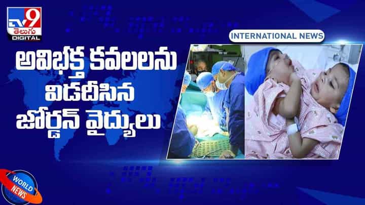 అవిభక్త కవలలను విడదీసిన జోర్డన్ వైద్యులు.. విజయవంతంగా అరుదైన ఆపరేషన్.. వీడియో అవిభక్త కవలలను విడదీసిన జోర్డన్ వైద్యులు.. విజయవంతంగా అరుదైన ఆపరేషన్.. వీడియో