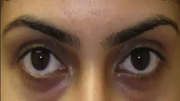 Dark Circles: డార్క్ సర్కిల్స్తో ఇబ్బంది పడుతున్నారా..! అయితే బాదంతో ఇలా చేయండి ..