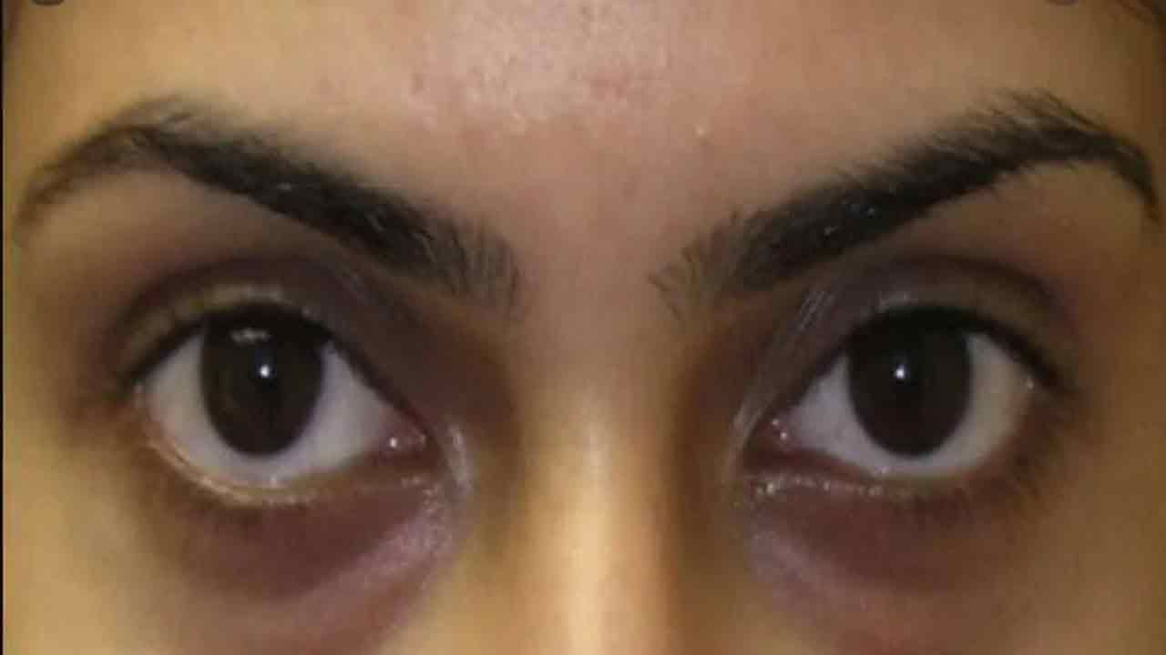 Dark Circles: డార్క్ స‌ర్కిల్స్‌తో ఇబ్బంది ప‌డుతున్నారా..! అయితే బాదంతో ఇలా చేయండి ..