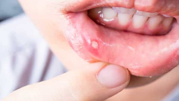 Health: నోటి పూత సమస్యతో బాధపడుతున్నారా..? ఈ నేచురల్ టిప్స్ పాటించండి.. మంచి ఫలితం ఉంటుంది..