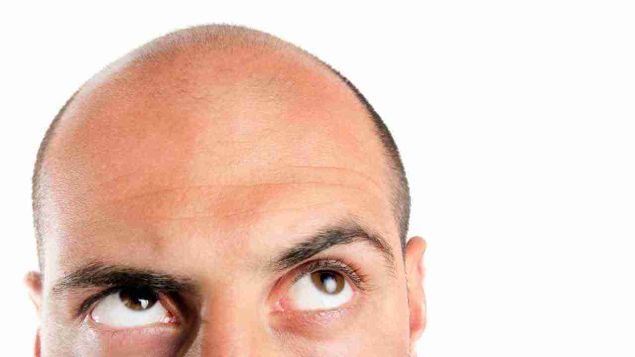 Hair Loss: శరీరంలో ఇవి లోపిస్తే బట్టతల వచ్చేస్తుంది..! ఏంటో తెలుసుకోండి..?