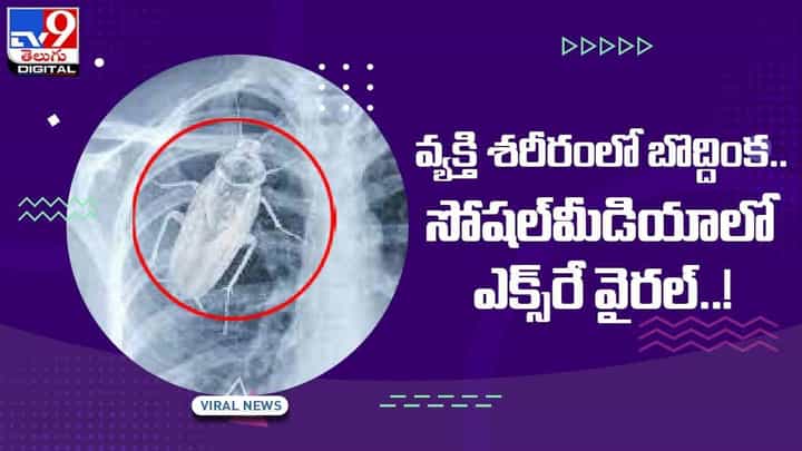 వ్యక్తి శరీరంలో బొద్దింక !! సోషల్మీడియాలో ఎక్స్రే వైరల్..! వ్యక్తి శరీరంలో బొద్దింక !! సోషల్మీడియాలో ఎక్స్రే వైరల్..!