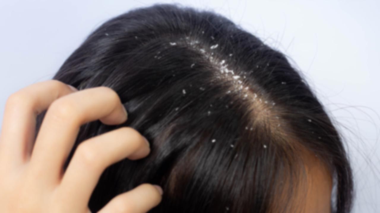 Dandruff: చుండ్రు సమస్యతో విసిగిపోయారా..! తక్కువ ఖర్చుతో ఇలా క్లియర్‌ చేసుకోండి..