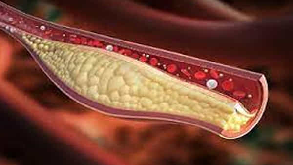 cholesterol: మీరు కొలెస్ట్రాల్తో బాధపడుతున్నారా.. అయితే ఇవి పాటించండి..