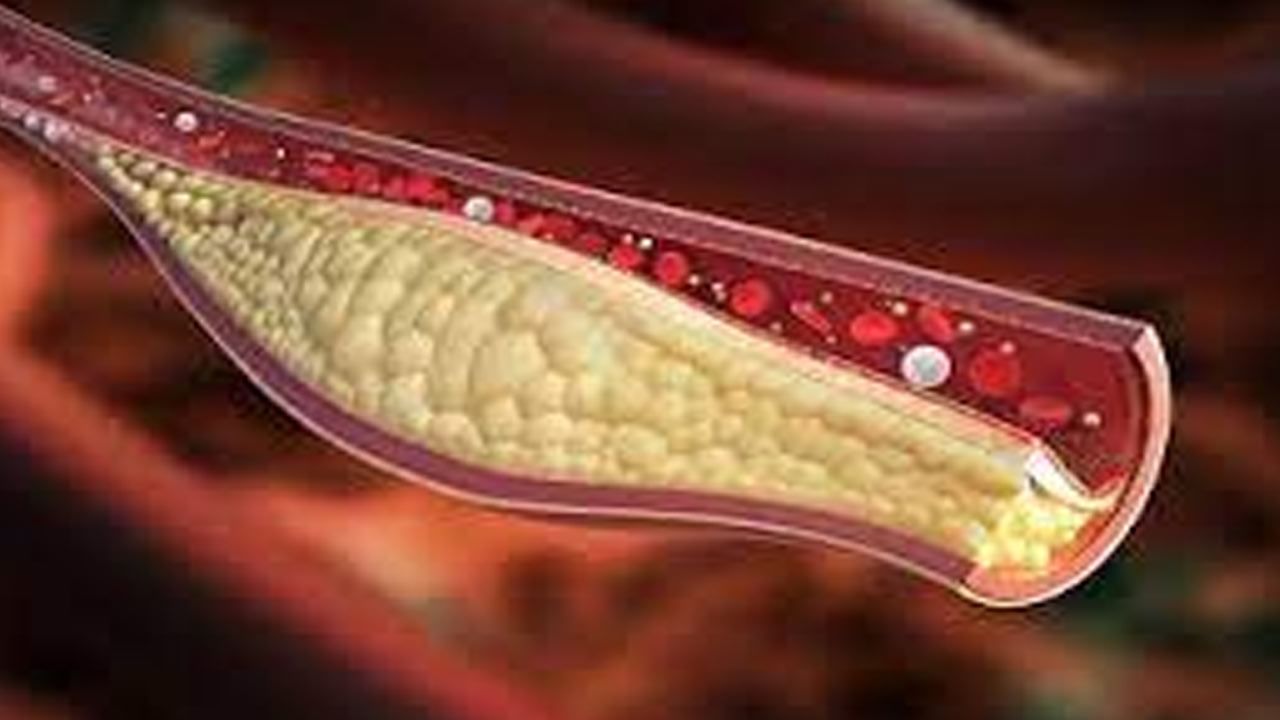 cholesterol: మీరు కొలెస్ట్రాల్‎తో బాధపడుతున్నారా.. అయితే ఇవి పాటించండి..