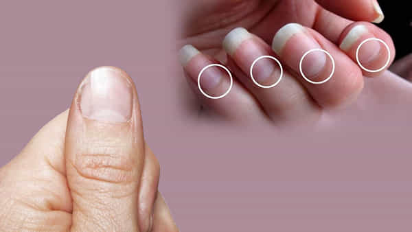 Fingernails: మీ చేతిగోళ్లలో దీనిని చూసి ఆనారోగ్య సమస్యలను గుర్తించవచ్చు.. ఏ రంగు మారితే ఎలాంటి వ్యాధులు వస్తాయి!