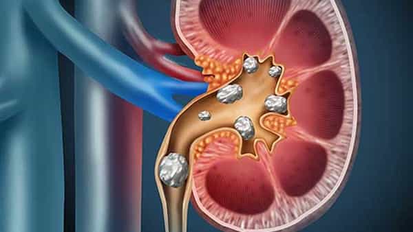 Home Remedies for Stone Problems: కిడ్నీ, పిత్తాశయంలో రాళ్ల సమస్యలా? వీటి ద్వారా ఉపశమనం పొందండి..!
