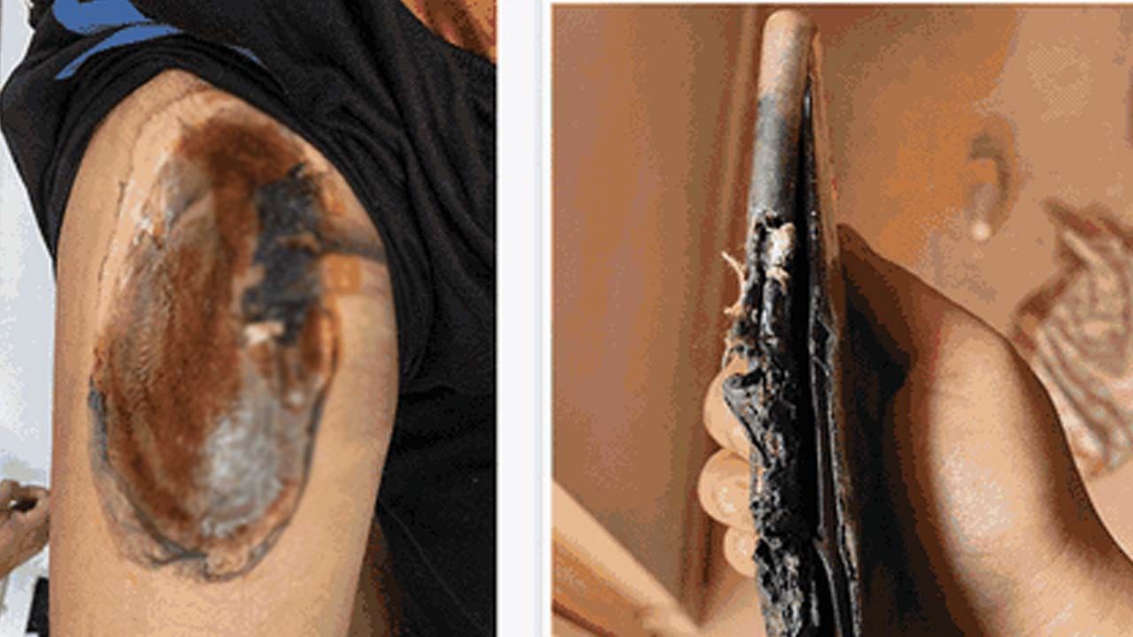 OnePlus Nord2: ఫోన్ పేలిపోవడంతో గాయపడిన వినియోగదారునికి వన్‌ప్లస్ భరోసా.. ఏం చేసిందంటే..