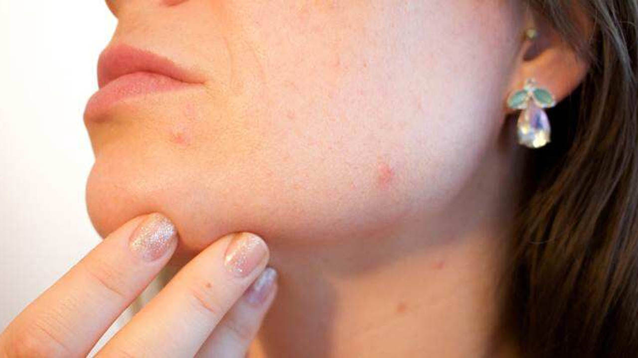 Pimples in Winter: చలికాలంలో వచ్చే చుండ్రుతో మొటిమల సమస్య కూడా మొదలవుతుంది.. దీనిని నుంచి బయటపడండి ఇలా!