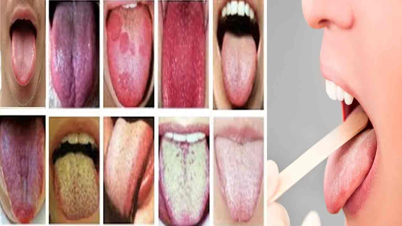 Tongue Colour: ముందుగా వైద్యులు నాలుకను ఎందుకు చూస్తారో తెలుసా..ఏ రంగు ఏ సమస్యని సూచిస్తుందంటే..