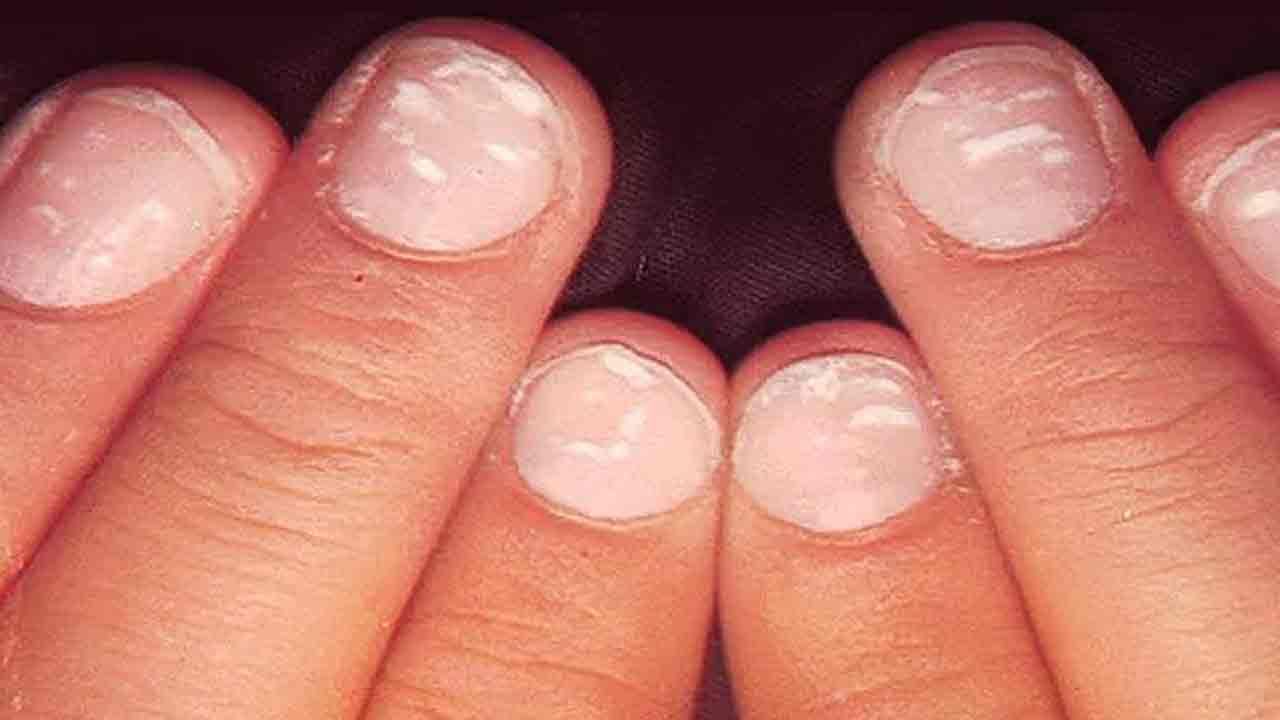 White spots in nails: Have white spots suddenly appear on the nails .. It  is advisable to consult a doctor immediately | White Spots on Nails: Your  Need To Know Guide | PiPa News
