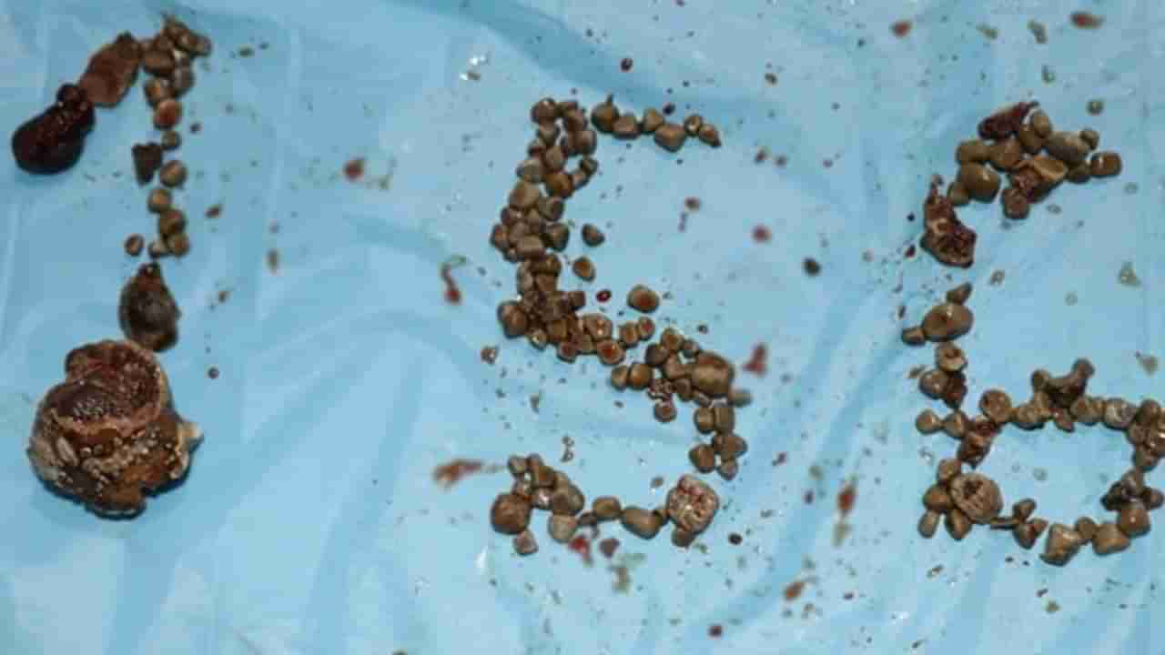 Hyderabad: కిడ్నీలో 156 రాళ్లు.. 350 గ్రాములకు పైనే బరువు.. విజయవంతంగా తొలగించిన హైదరాబాద్‌ వైద్యులు..