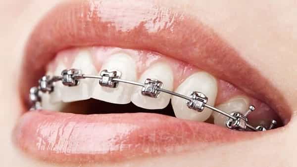 Teeth: దంతాలకు బ్రేస్ అమర్చితే జాగ్రత్త..! ఈ సమస్యలు ఉండే అవకాశం..