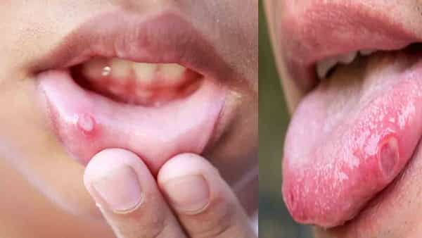 Mouth Ulcers: నోటి పూతతో ఇబ్బందులు పడుతున్నారా..? ఈ చిట్కాలు పాటిస్తే తక్షణ ఉపశమనం..