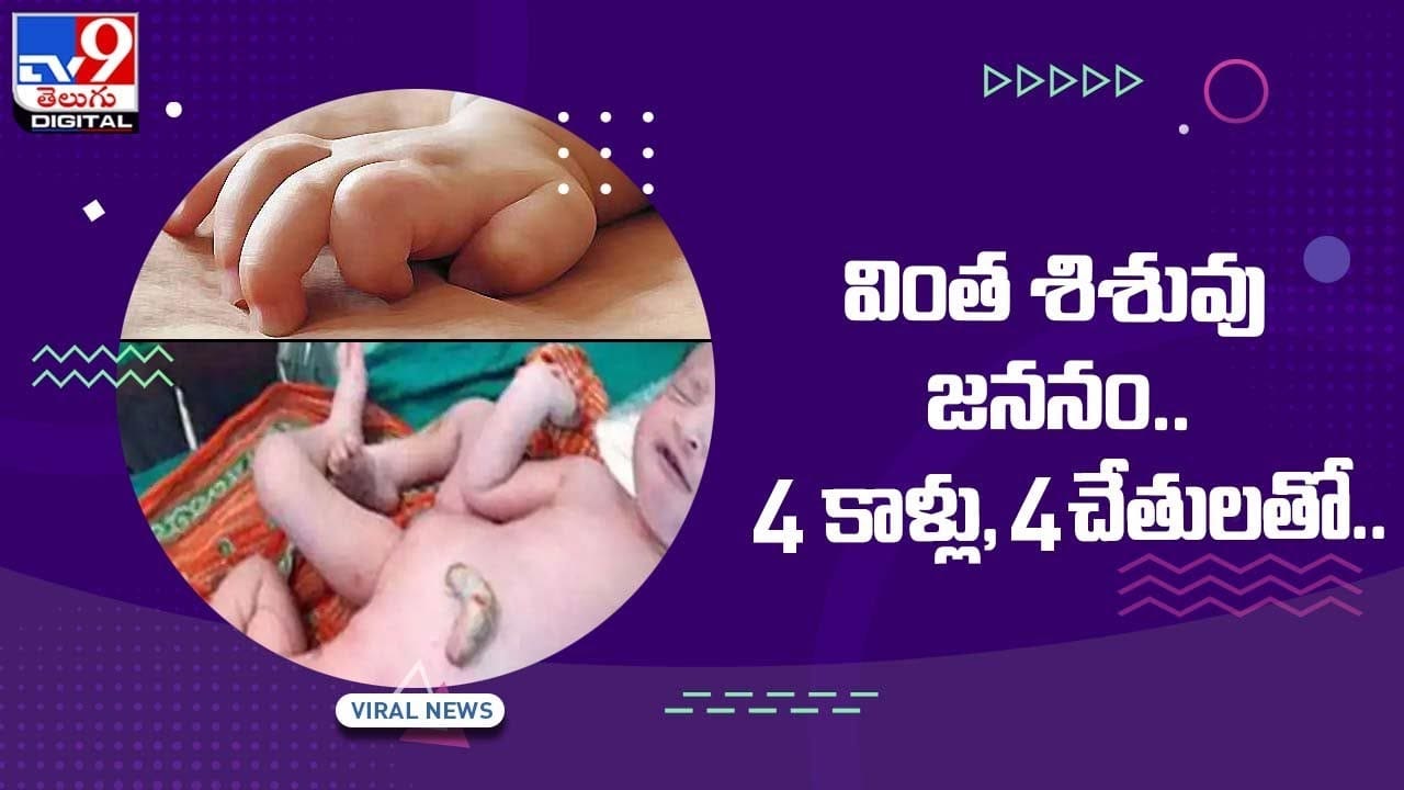 వింత శిశువు జననం !! నాలుగు కాళ్లు, నాలుగు చేతులతో !! వీడియో