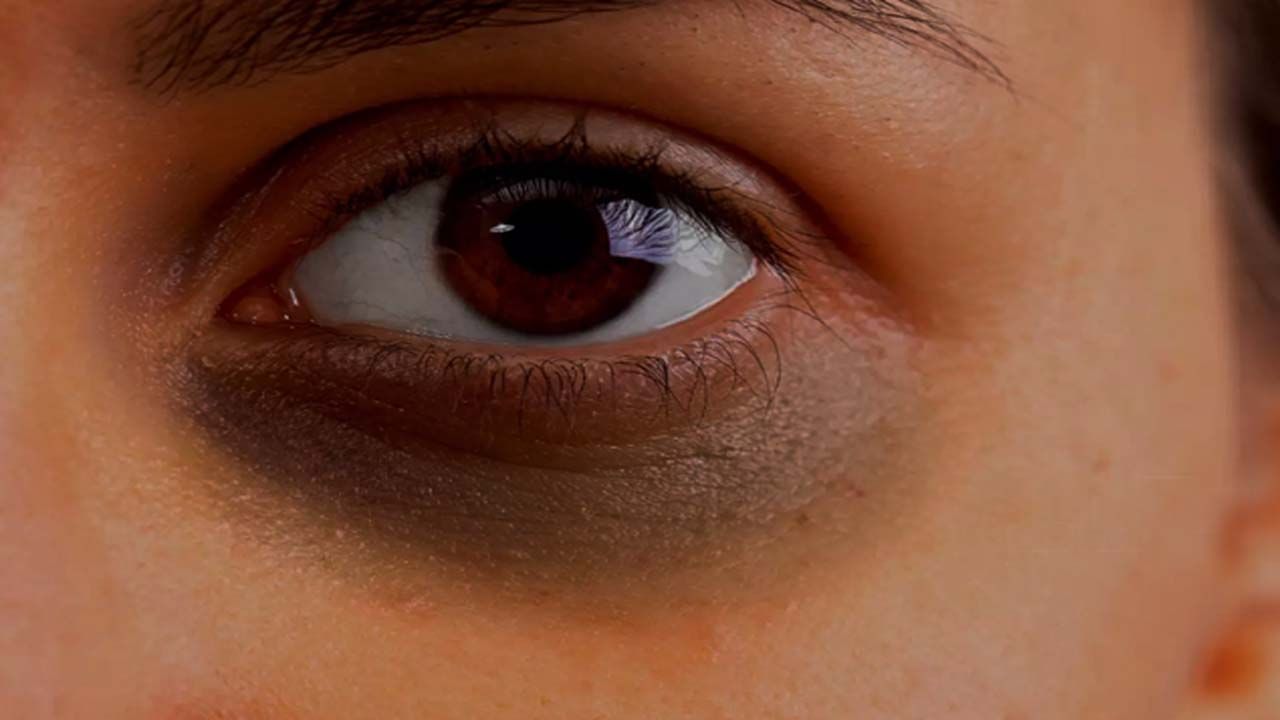 Eye Dark Circles: మీ కళ్ల కింద నల్లటి వలయాలతో ఇబ్బంది పడుతున్నారా..? వాటిని పోగొట్టడం ఎలా..?