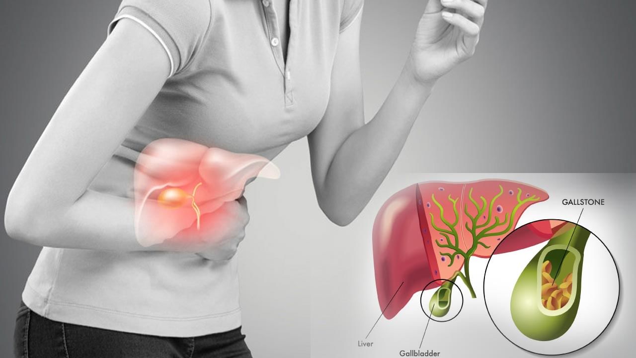 Gallbladder Stone: గాల్ బ్లాడర్‌లో రాళ్లతో ఇబ్బంది పడుతున్నారా.. అయితే ఈ విషయం తెలుసుకోండి..