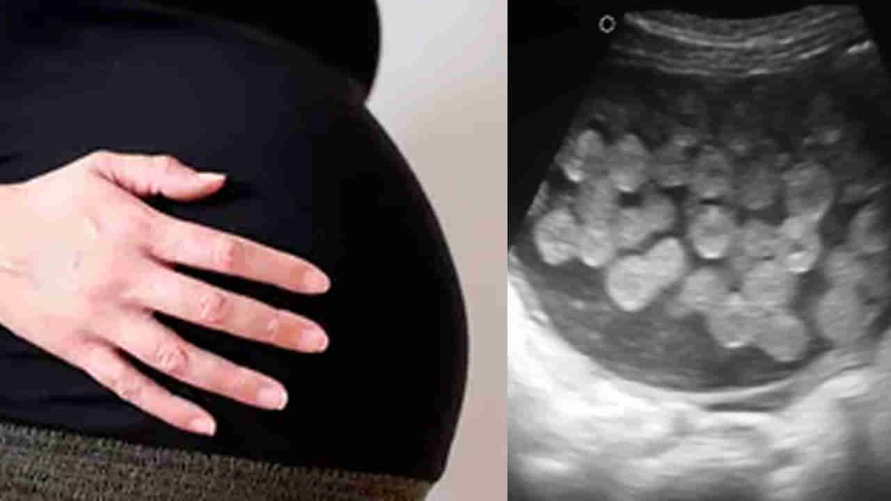 Molar pregnancy: గర్భం ఏర్పడుతుంది కానీ బిడ్డ ఉండదు.. మీకు ముత్యాల గర్భం గురించి తెలుసా..?