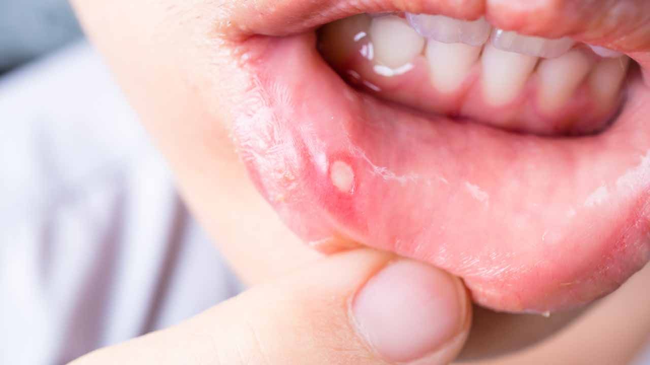 Mouth Ulcers: నోటి పూతతో ఇబ్బంది పడుతున్నారా..? అయితే ఈ సింపుల్ చిట్కాలతో చెక్ పెట్టండి