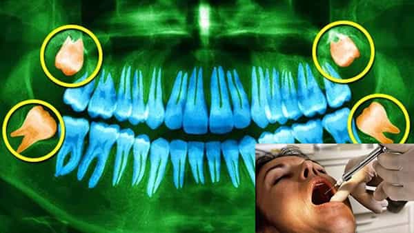 Wisdom Teeth: జ్ఞాన దంతాల వల్ల మనిషి మేధస్సు, ఆలోచనా సామర్థ్యం పెరుగుతుందా..? పరిశోధకులు ఏమంటున్నారు?