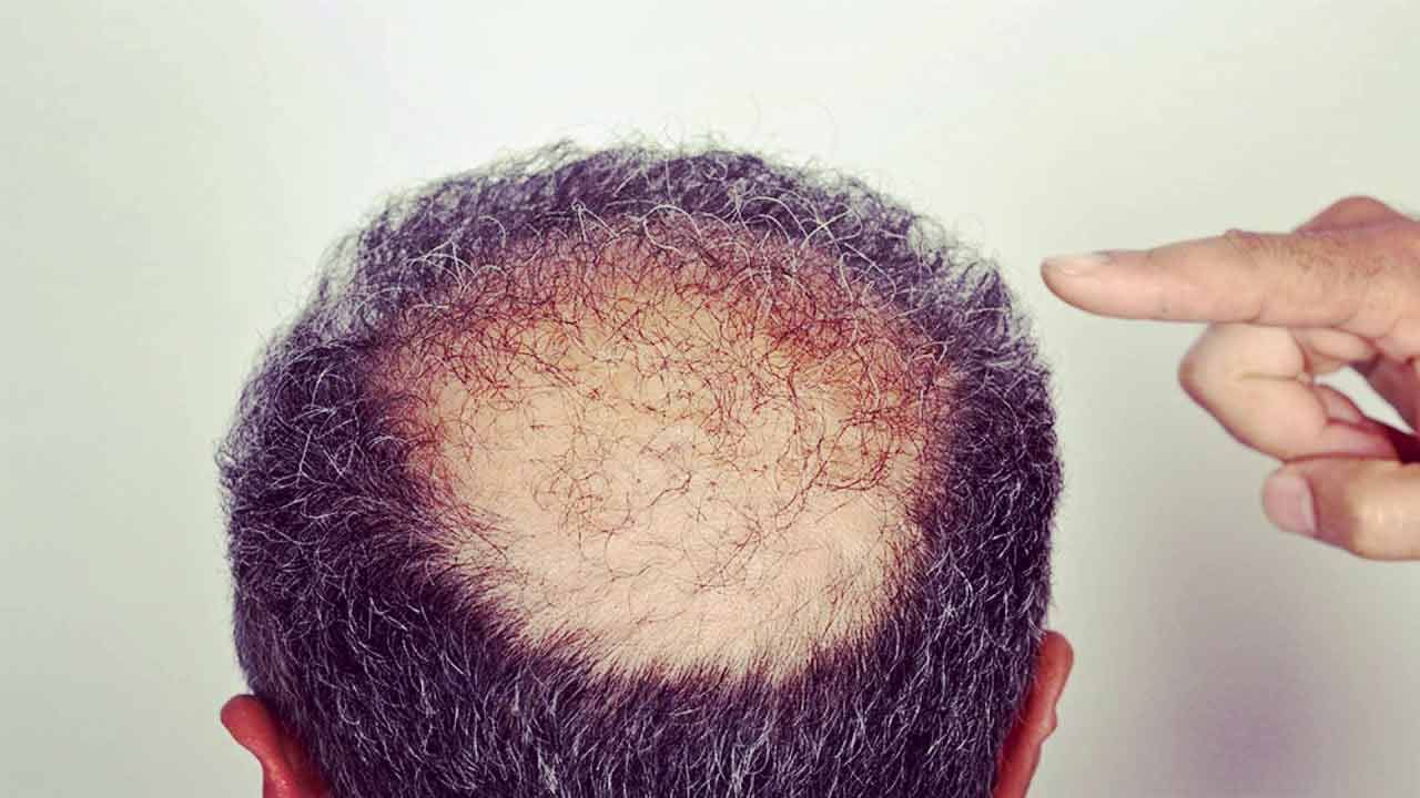 Shocking: Went to the clinic to get bald hair … when he got home … | India:  Military policeman dies after hair transplant in Patna | PiPa News