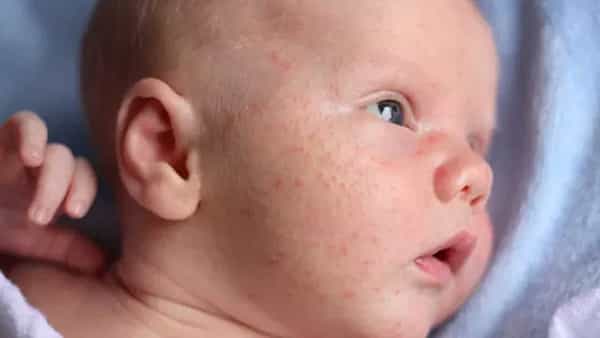 Toddler Skin Care: మీ పిల్లల మొఖంపై మచ్చలు వస్తున్నాయా? అయితే, ఈ విషయాలపై జాగ్రత్తగా ఉండండి..