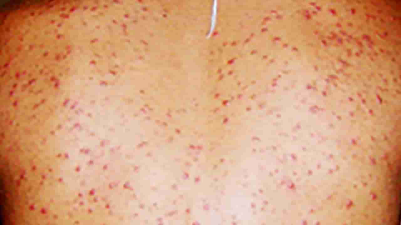 Skin Diseases: చర్మంపై ఈ లక్షణాలు ఉన్నాయా.. అయితే ప్రమాదం పొంచి ఉన్నట్లే..