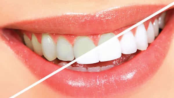 Teeth: దంతాల రంగు మారడానికి మీరు చేసే ఈ 5 తప్పులే కారణం.. అవేంటంటే..?