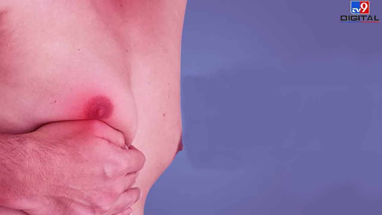Breast Cancer in Men: పురుషుల్లోనూ రొమ్ము క్యాన్సర్.. ఈ లక్షణాలుంటే వెంటనే అలర్ట్ అవ్వండి..!