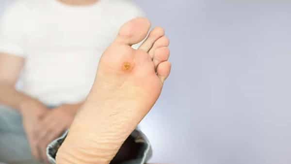 Diabetes Care: డయాబెటిక్ బాధితులకు అలర్ట్.. శరీరంపై ఇలాంటి పుండ్లు కనిపిస్తే అస్సలు నిర్లక్ష్యం చేయకండి..