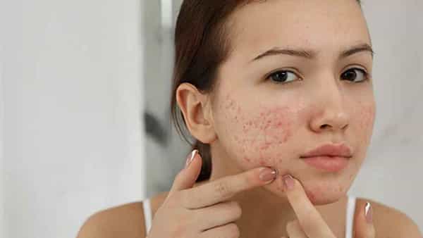 Health Tips: ముఖంపై వేడి మొటిమలతో ఇబ్బందిపడుతున్నారా.. సింపుల్గా ఇలా చేయండి..!