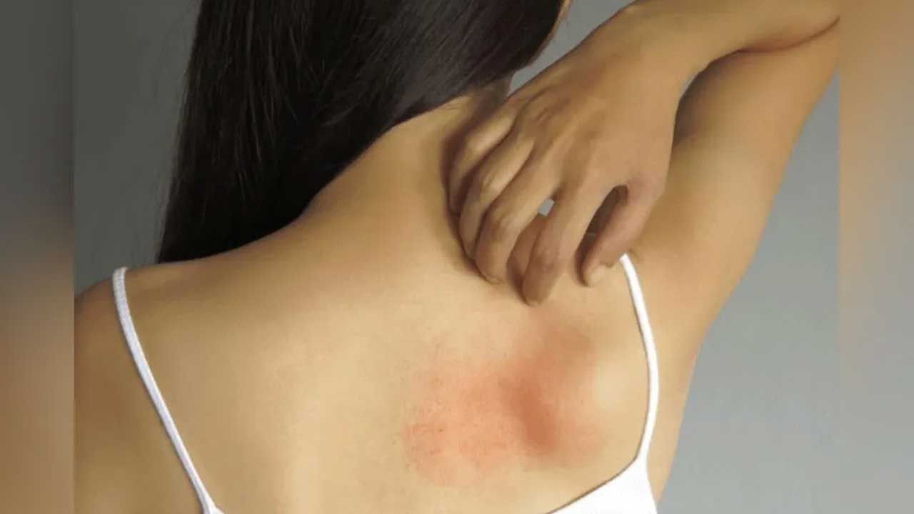 Heat Rashes: ఎండాకాలం హీట్‌ ర్యాషెస్‌ సమస్య వేధిస్తుందా.. ఇంట్లోనే వీటిని ట్రై చేయండి..!