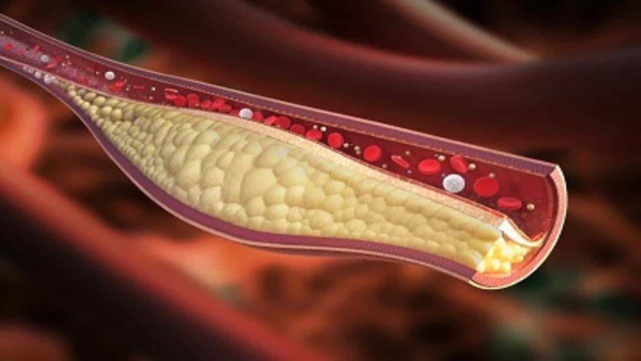 శరీరంలో చెడు కొలెస్ట్రాల్ పెరిగితే ముఖ్యంగా ఇలాంటి లక్షణాలు కనిపిస్తాయి. అవేంటో తెలుసుకోండి..