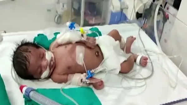 Telangana News: చిన్నారి చనిపోయిందని అంత్యక్రియలు చేయబోయారు. చివరి నిమిషంలో ఊహించని పరిణామం