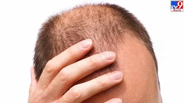Bald Head: బట్టతల ఉన్నవారికి గుడ్ న్యూస్.. ఇక జుట్టు కోసం బెంగ అవసరం లేదు..!