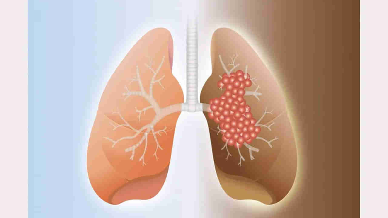 Lungs Infection: కరోనా నుంచి కోలుకున్న తర్వాత వెంటాడుతున్న ఊపిరితిత్తుల ఫైబ్రోసిన్ వ్యాధి.. దీనిని ఎలా నివారించాలి..?