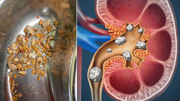 Kidney Stone: కిడ్నీల్లో రాళ్లు అందుకే ఏర్పడతాయంట.. చెక్ పెట్టాలంటే ఇలా చేయండి..