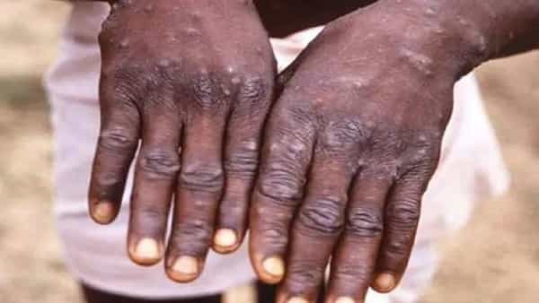 Monkeypox: భారత్లో మంకీపాక్స్ కలకలం.. ఐదేళ్ల చిన్నారి నుంచి నమూనాల సేకరణ..