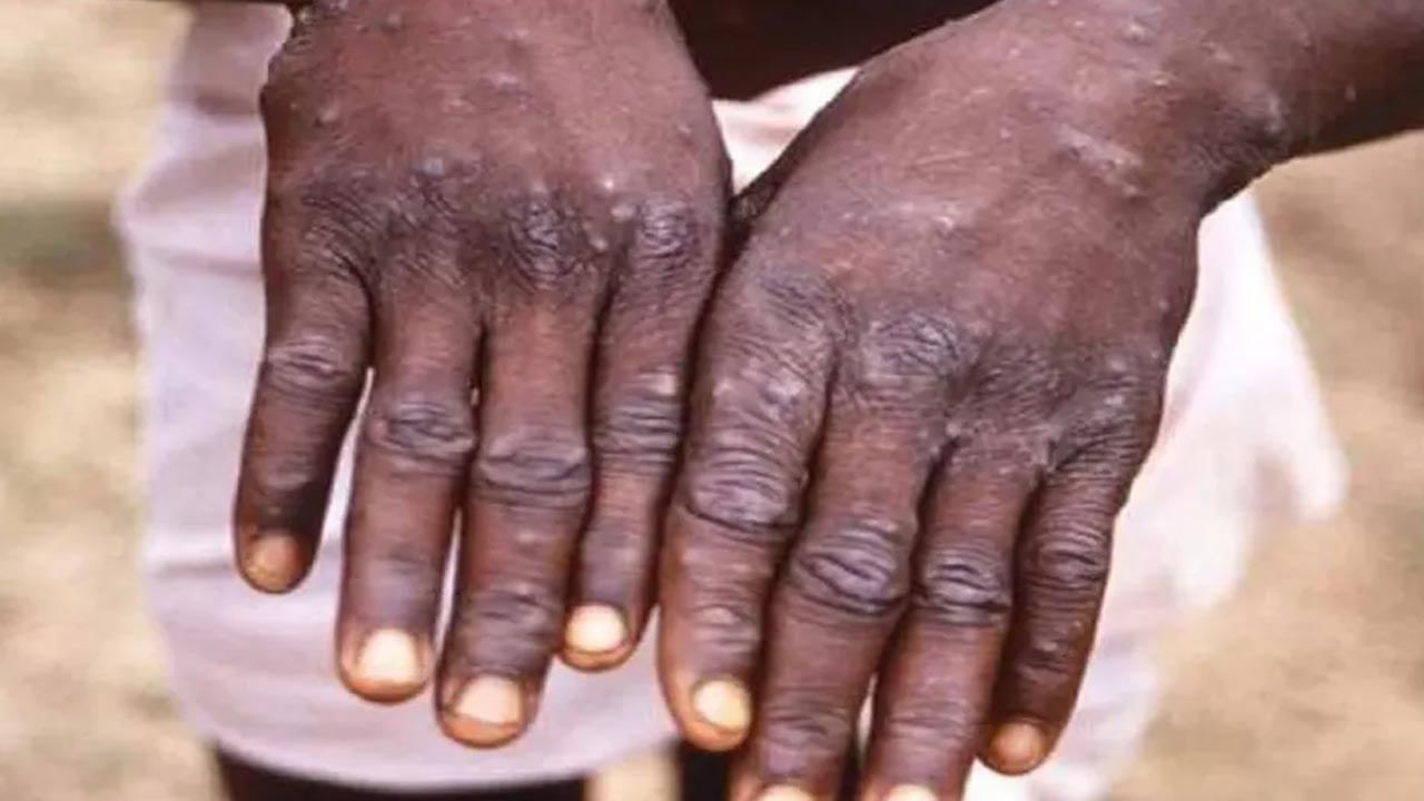 Monkeypox: భారత్‌లో మంకీపాక్స్ కలకలం.. ఐదేళ్ల చిన్నారి నుంచి నమూనాల సేకరణ..