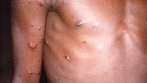 Monkeypox: భార‌త్‌లో మంకీపాక్స్ అలర్ట్.. రాష్ట్రాలకు మార్గదర్శకాలు విడుదల చేసిన కేంద్రం