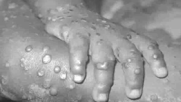 Monkeypox Alert: ప్రపంచాన్ని వణికిస్తోన్న మంకీ వైరస్.. భారత్లో అడుగు పెట్టేనా..? ఏలాంటి జాగ్రత్తలు తీసుకోవాలంటే..!
