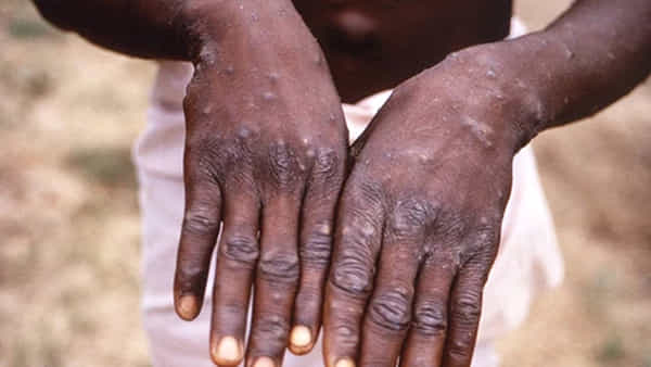 Monkeypox: అమెరికాలో అడుగుపెట్టిన మంకీపాక్స్.. బోస్టన్ నగరంలో ఒకరికి సోకినట్టు నిర్ధారణ..!