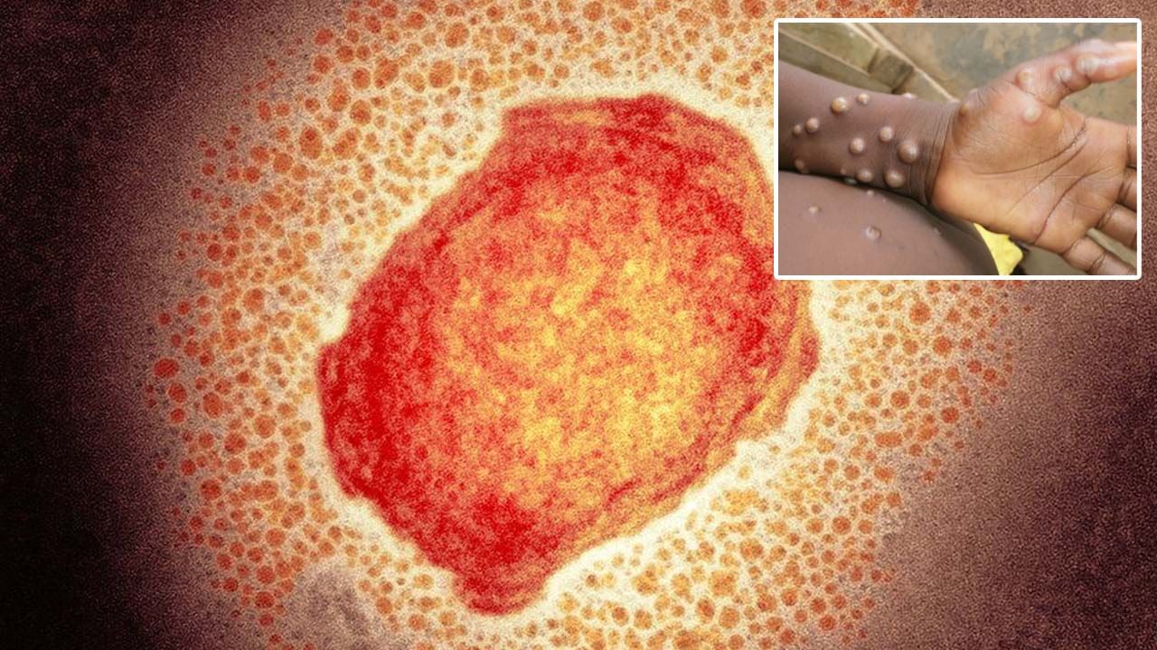 Monkeypox Virus: భయాందోళన కలిగిస్తున్న మరో కొత్త వైరస్‌.. ఇది ఎలా వ్యాపిస్తుంది..? ఎలాంటి లక్షణాలు