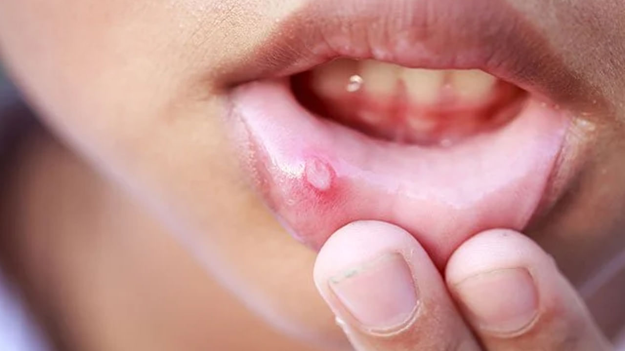 Mouth Ulcer: నోటిపూత సమస్యతో బాధపడుతున్నారా.? ఇలా చేస్తే వెంటనే ఫలితం ఉంటుంది..