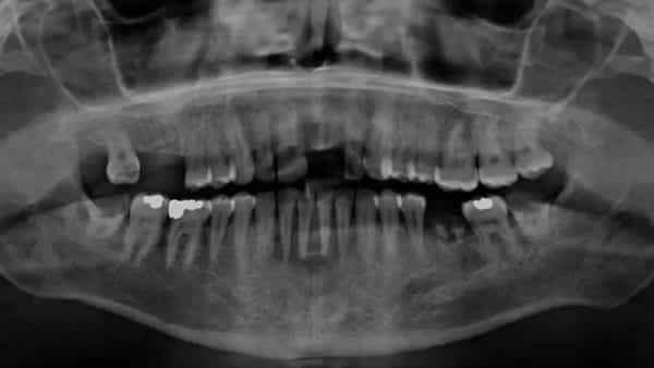 Oral Cancer: యువతలో అధికంగా పెరుగుతోన్న పొగాకు ఉత్పత్తుల వాడకం.. 30 ఏళ్లలోపు వారికి ఓరల్ క్యాన్సర్..