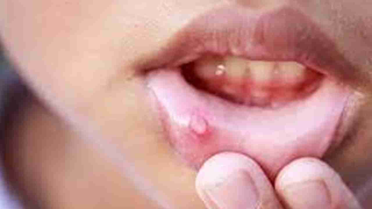 Oral Cancer:ఈ లక్షణాలు కనిపిస్తే నోటి క్యాన్సర్.. పరిశుభ్రత పాటించకపోతే అంతే సంగతులు..!