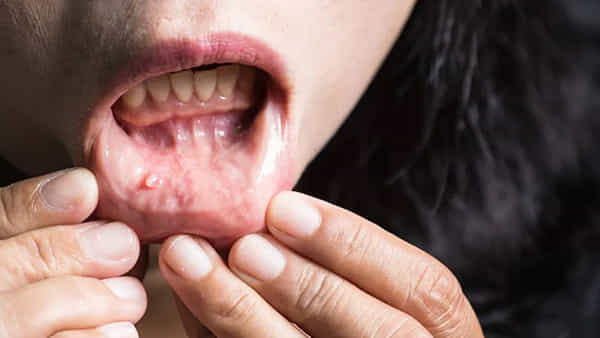 Oral Cancer: రోజు రోజుకి పెరుగుతున్న నోటి క్యాన్సర్ కేసులు.. 30 ఏళ్ల కంటే తక్కువ వయసున్నవారిలో అధికం..!